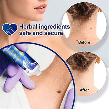 Wartsoff Instant Blemish Removal Cream Of…